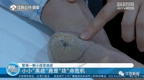 头条医生科普脚底痣,脚底痣的形成原因及预防措施揭秘