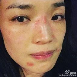 明星吃过敏,美食诱惑下的健康挑战